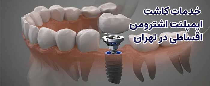 ایمپلنت سوئیسی اشترومن اقساطی در تهران